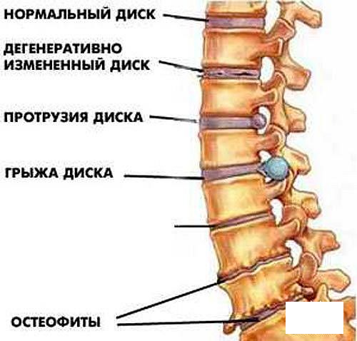 Остеонодроз1.jpg