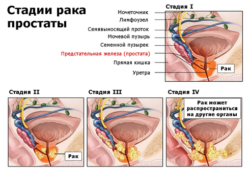 степени-рака-простаты1.png