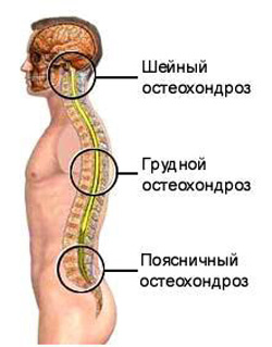 Остеонодроз2.jpg